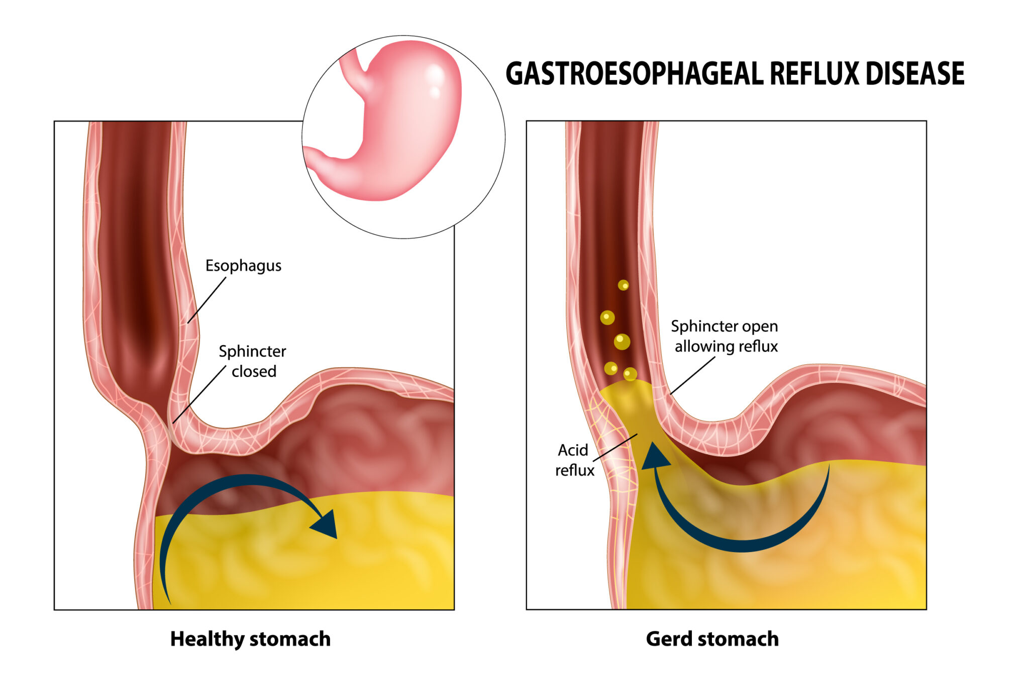 Acid Reflux Surgery Campbelltown Hiatal Hernia Repair And Fundoplication