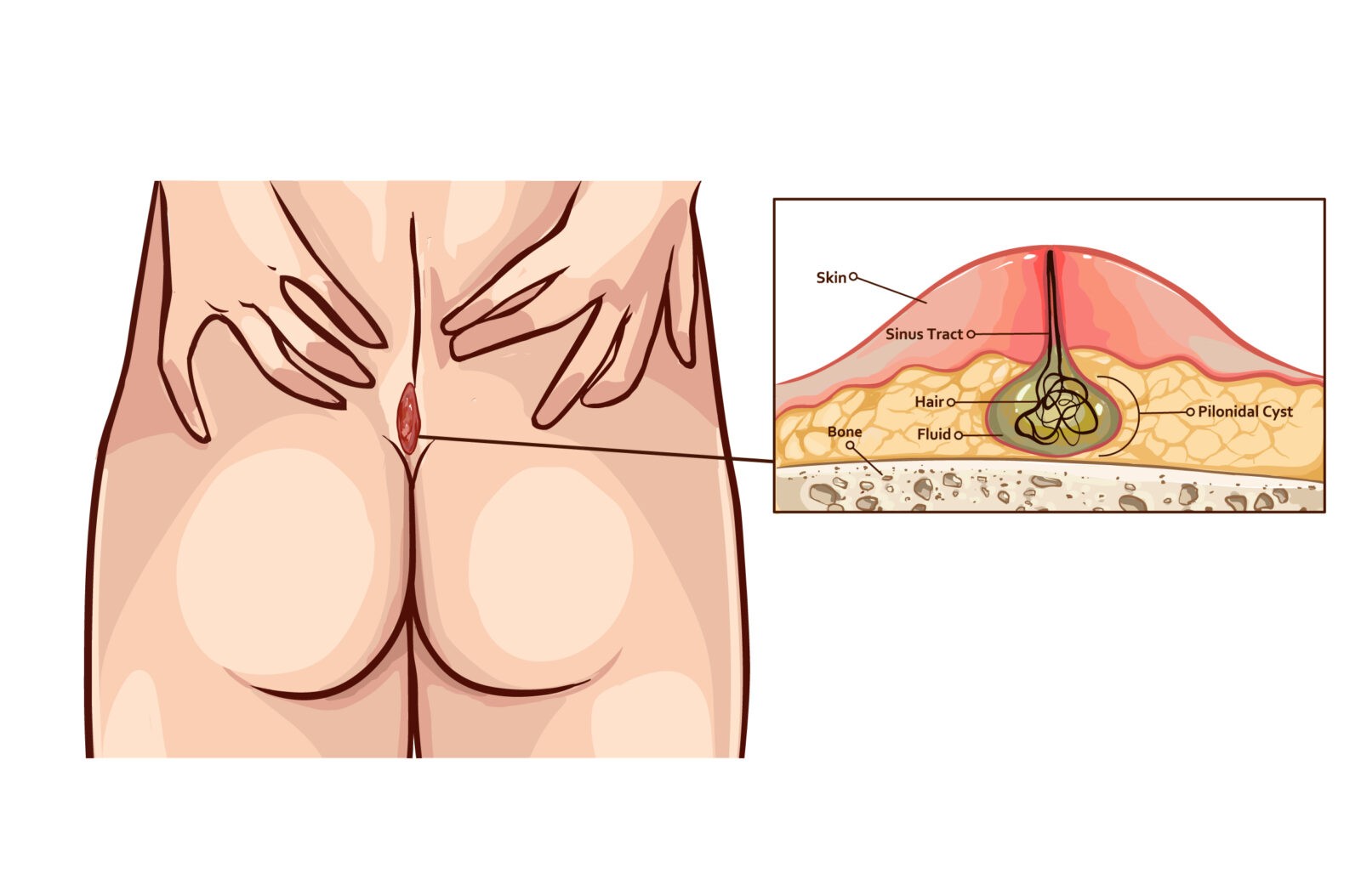 CSA Surgical Center - Pilonidal Cyst Removal